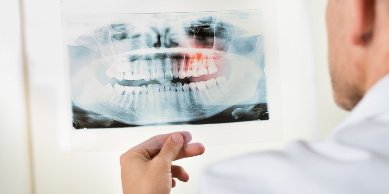 Schiefe Zähne erschweren die Zahnpflege