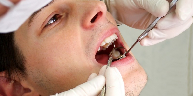 Bei Karies ist eine Zahnarztbehandlung notwendig