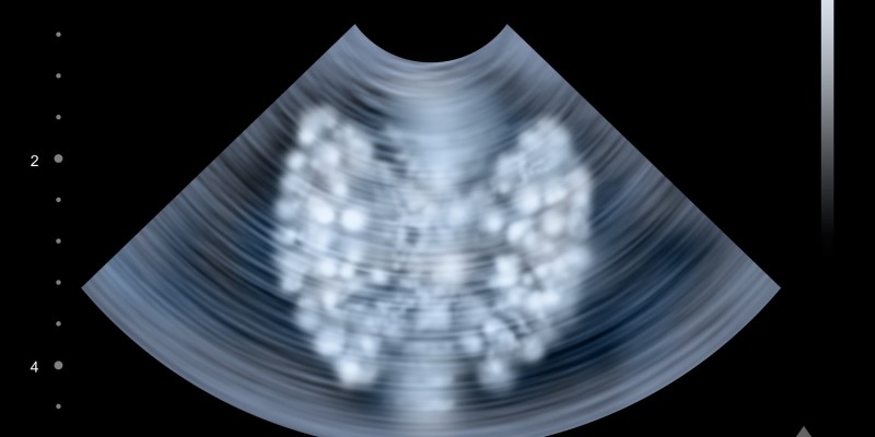 Die Schilddrüse im Ultraschallbild