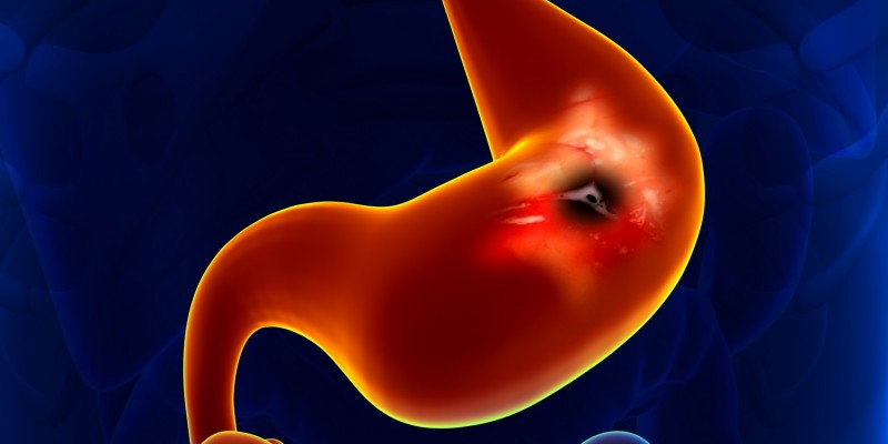 Aus einer Magenschleimhautentzündung kann sich ein Magengeschwür entwickeln