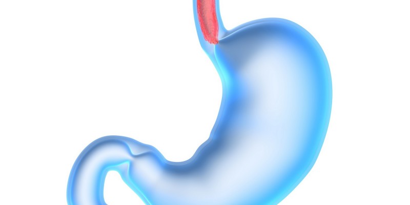 Magensäure fließt zurück in die Speiseröhre