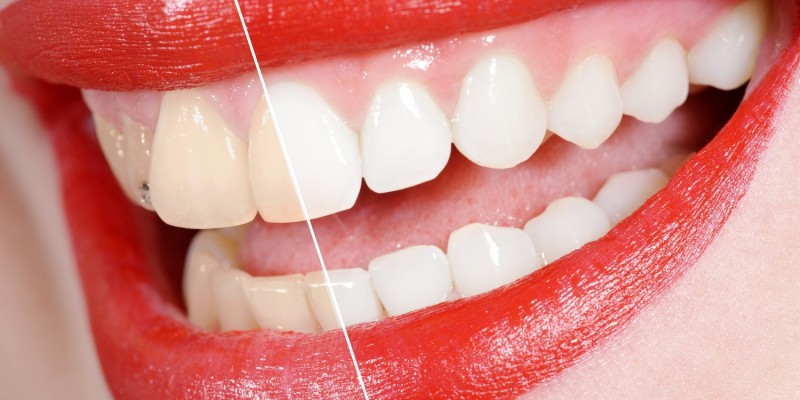 Verfärbte und weiße Zähne im Vergleich