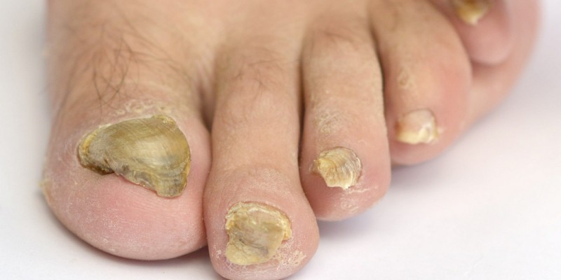 Nagelverformungen durch Nagelpilzinfektion am Fuß