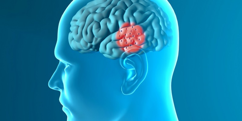 Betroffene Hirnregion bei Parkinson